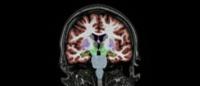 Brain MRI